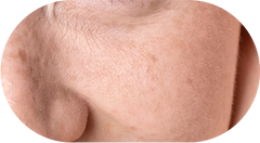 Dry Skin